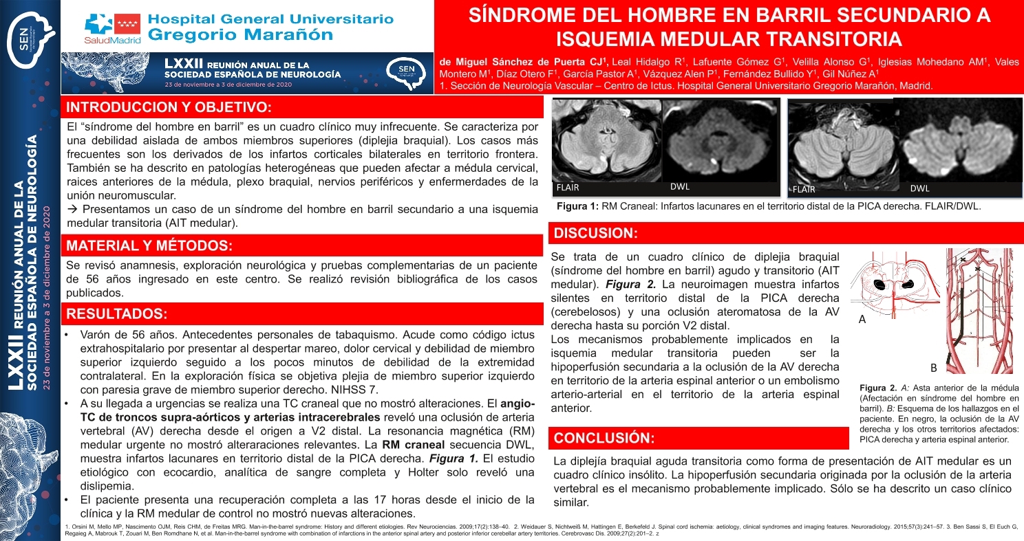 Síndrome del hombre en barril secundario a isquemia medular transitoria