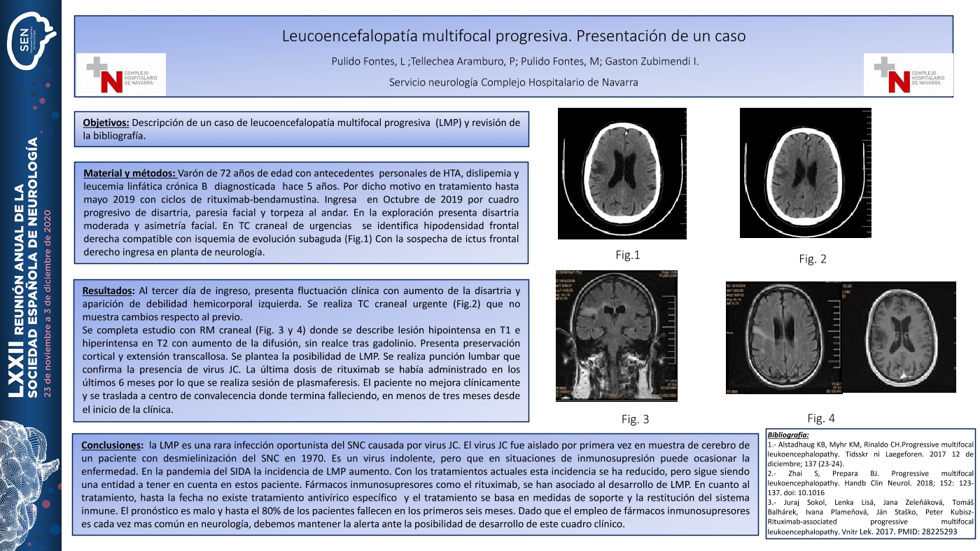 Leucoencefalopatía multifocal progresiva. Caso clínico y revisión bibliográfica.