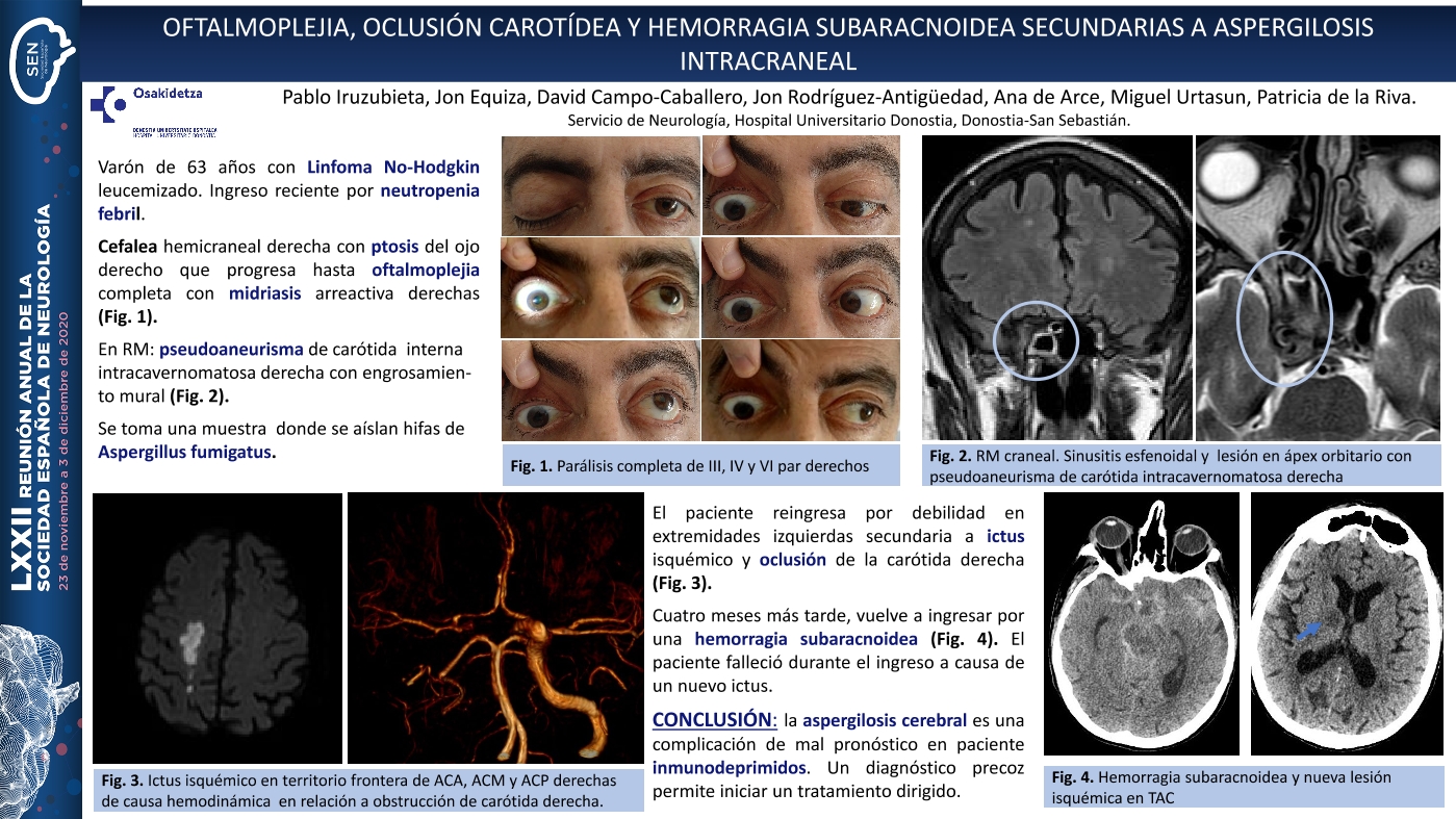Oftalmoplejia y oclusión carotídea secundarias a aspergilosis intracraneal