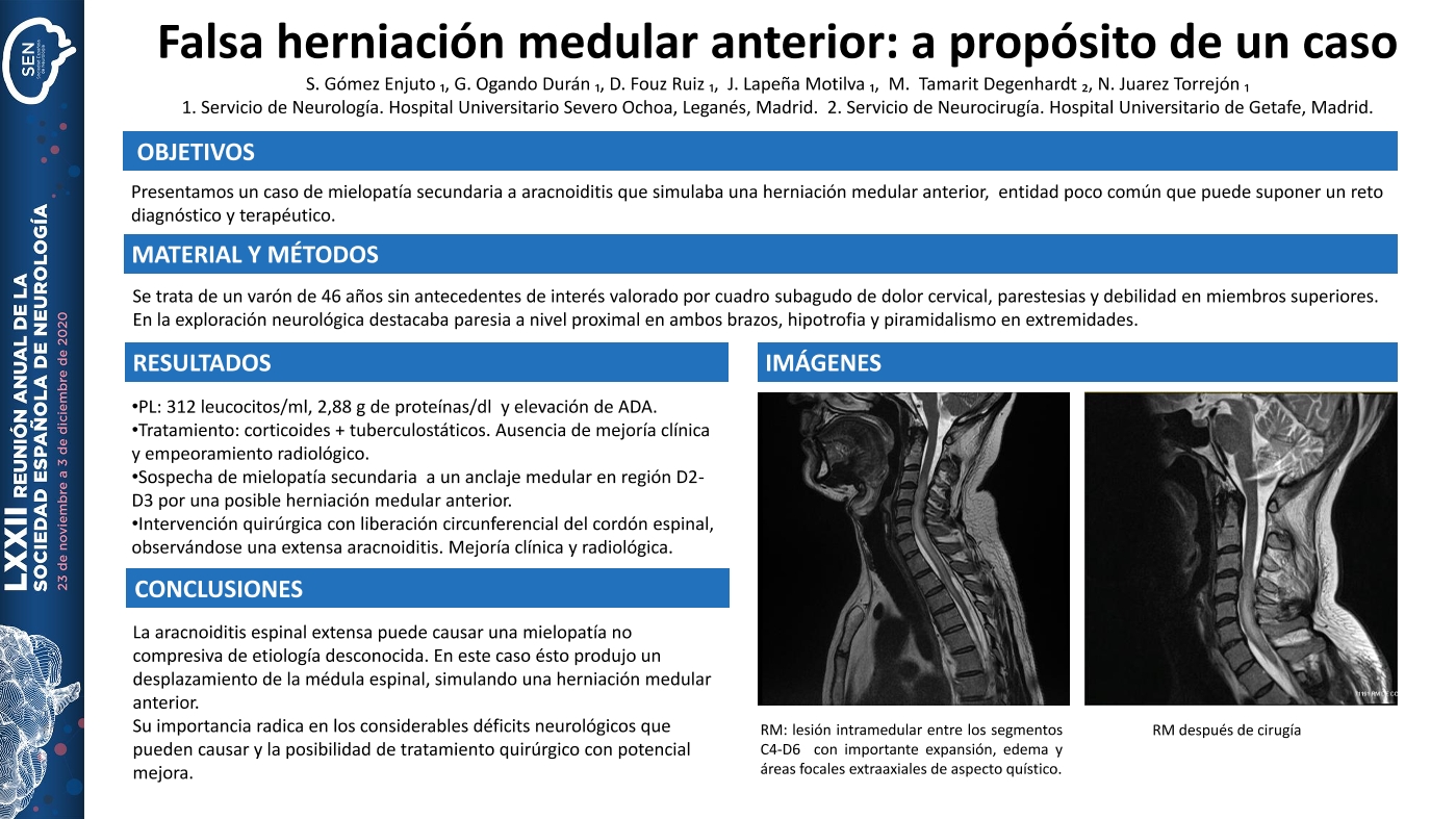 Falsa herniación medular anterior: a propósito de un caso
