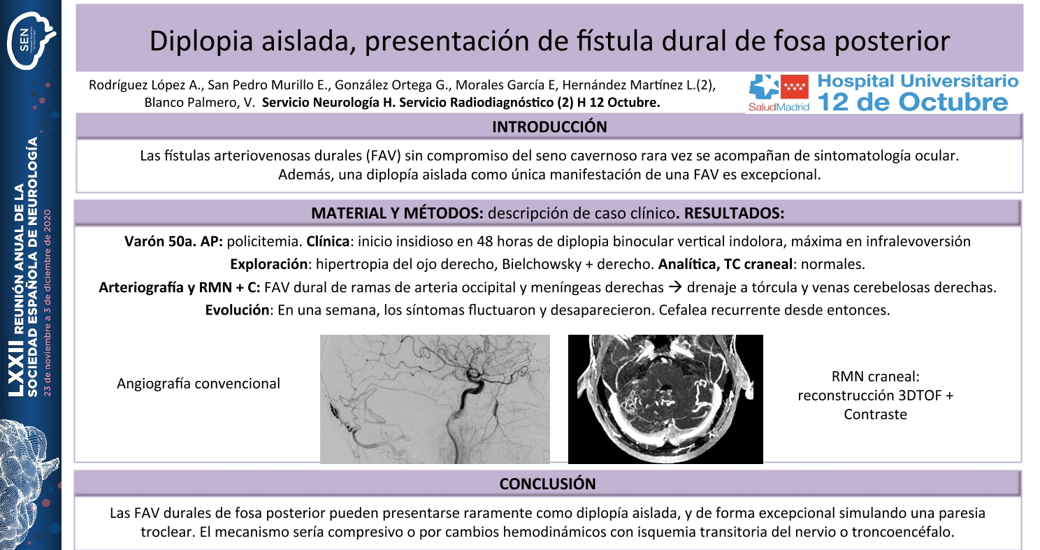 Diplopia aislada como presentación de una fístula arteriovenosa dural de fosa posterior