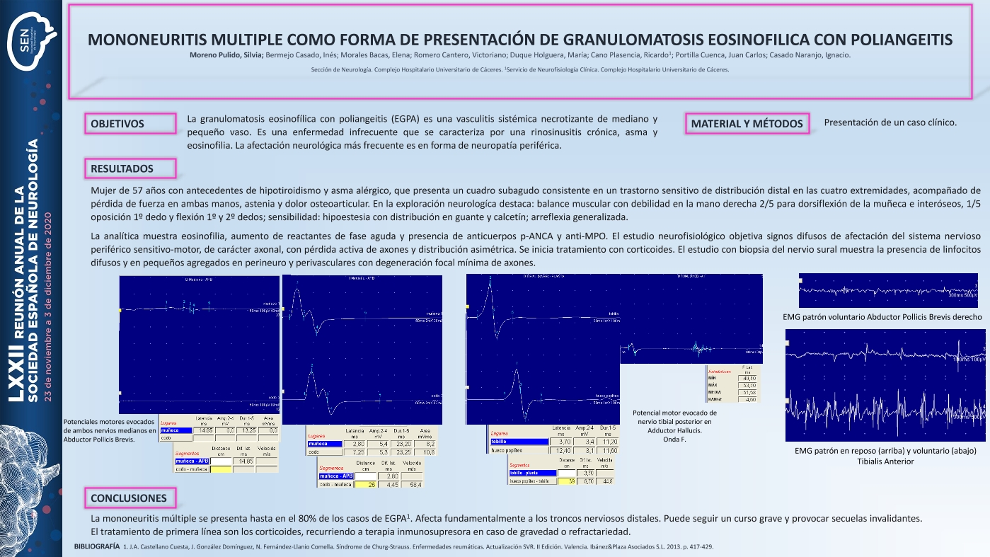 Mononeuritis múltiple como forma de presentación de granulomatosis eosinofílica con poliangeitis