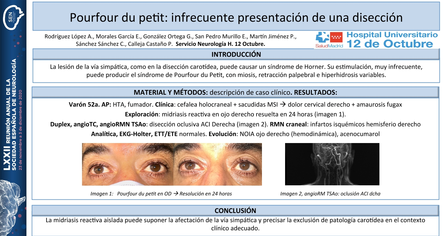 Pourfour du petit: infrecuente presentación de una disección