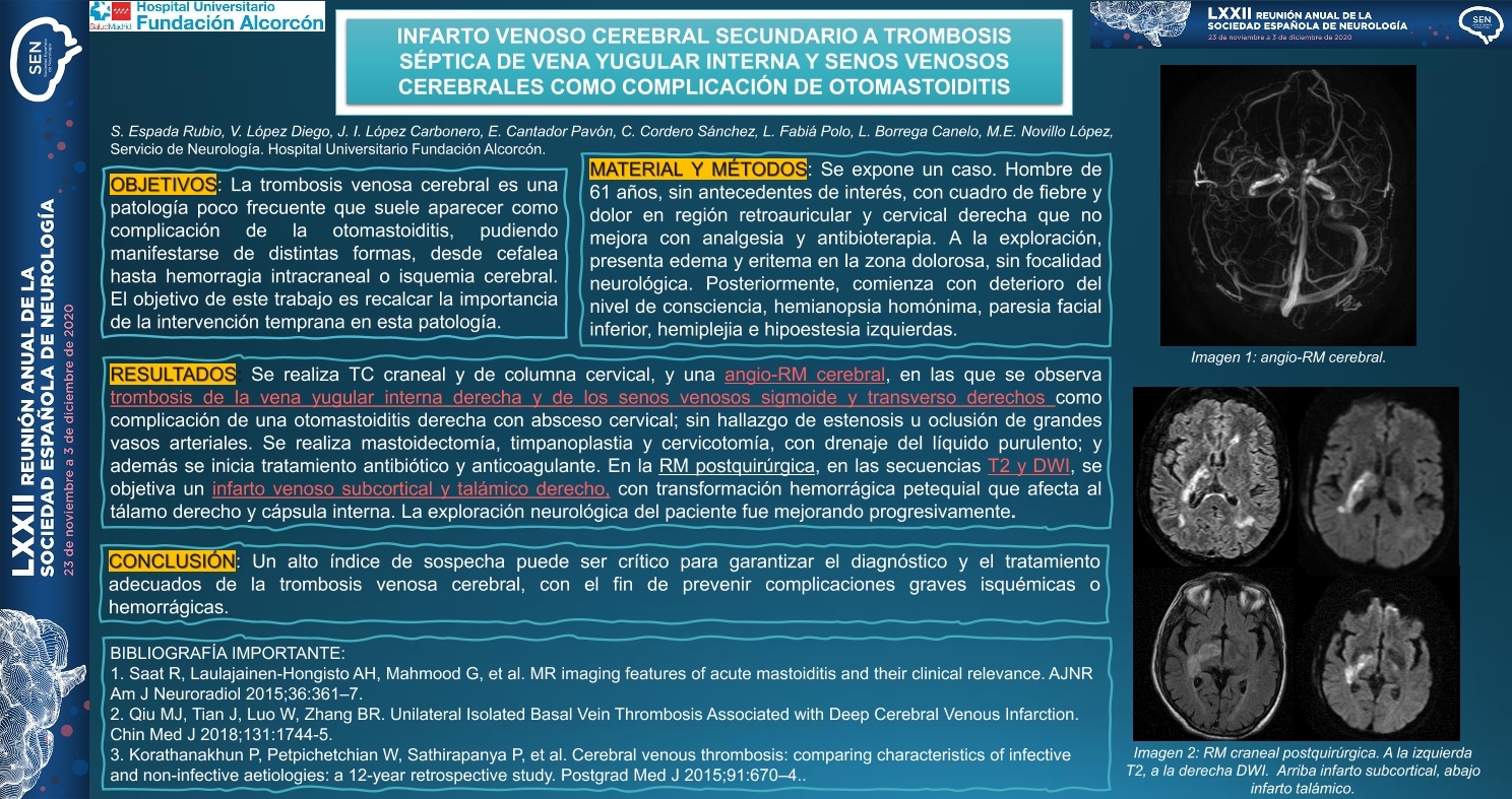 Infarto venoso cerebral secundario a trombosis séptica de vena yugular interna y senos venosos cerebrales como complicación de otomastoiditis