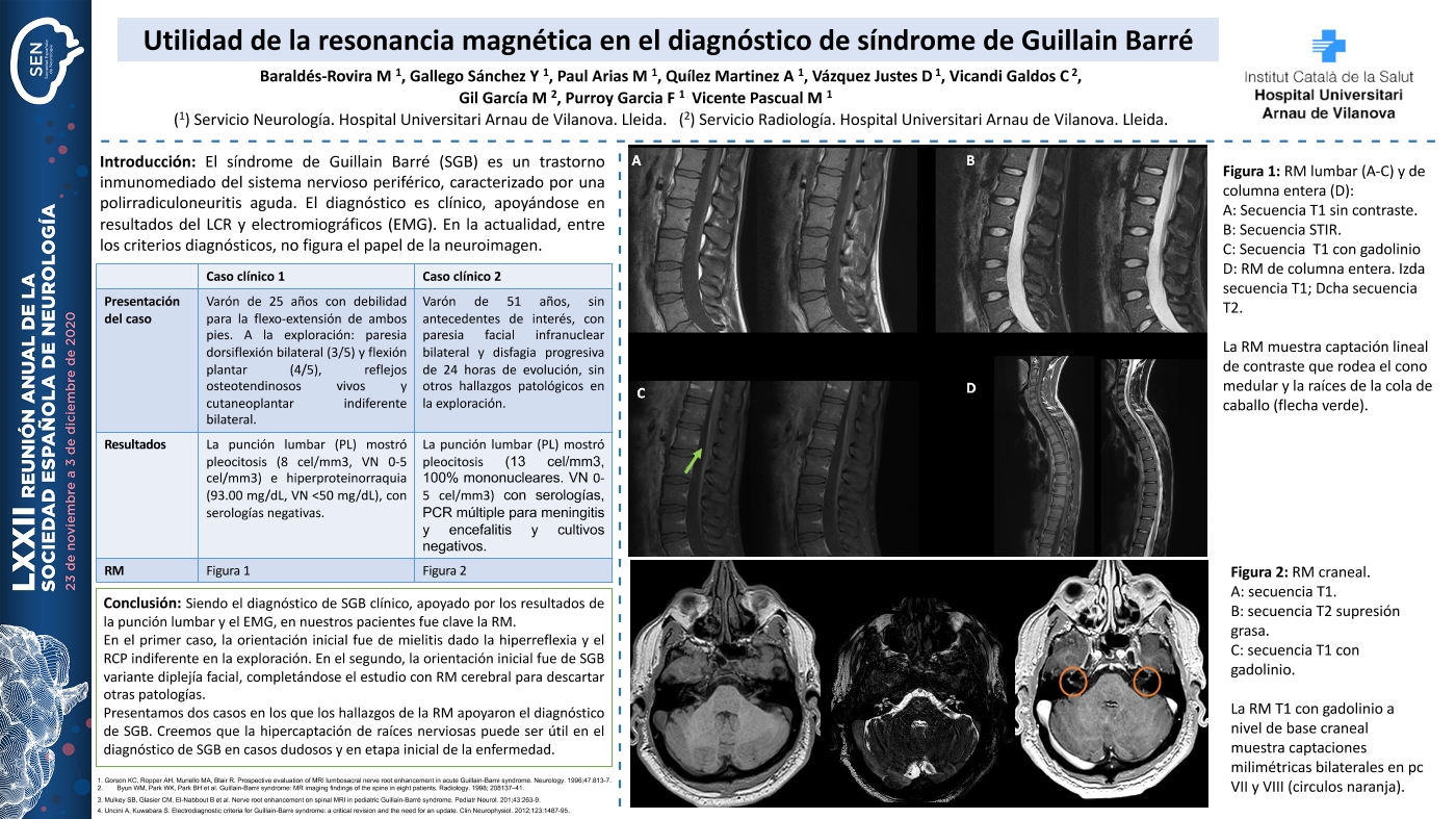 Utilidad de la resonancia magnética en el diagnóstico de síndrome de Guillain Barré