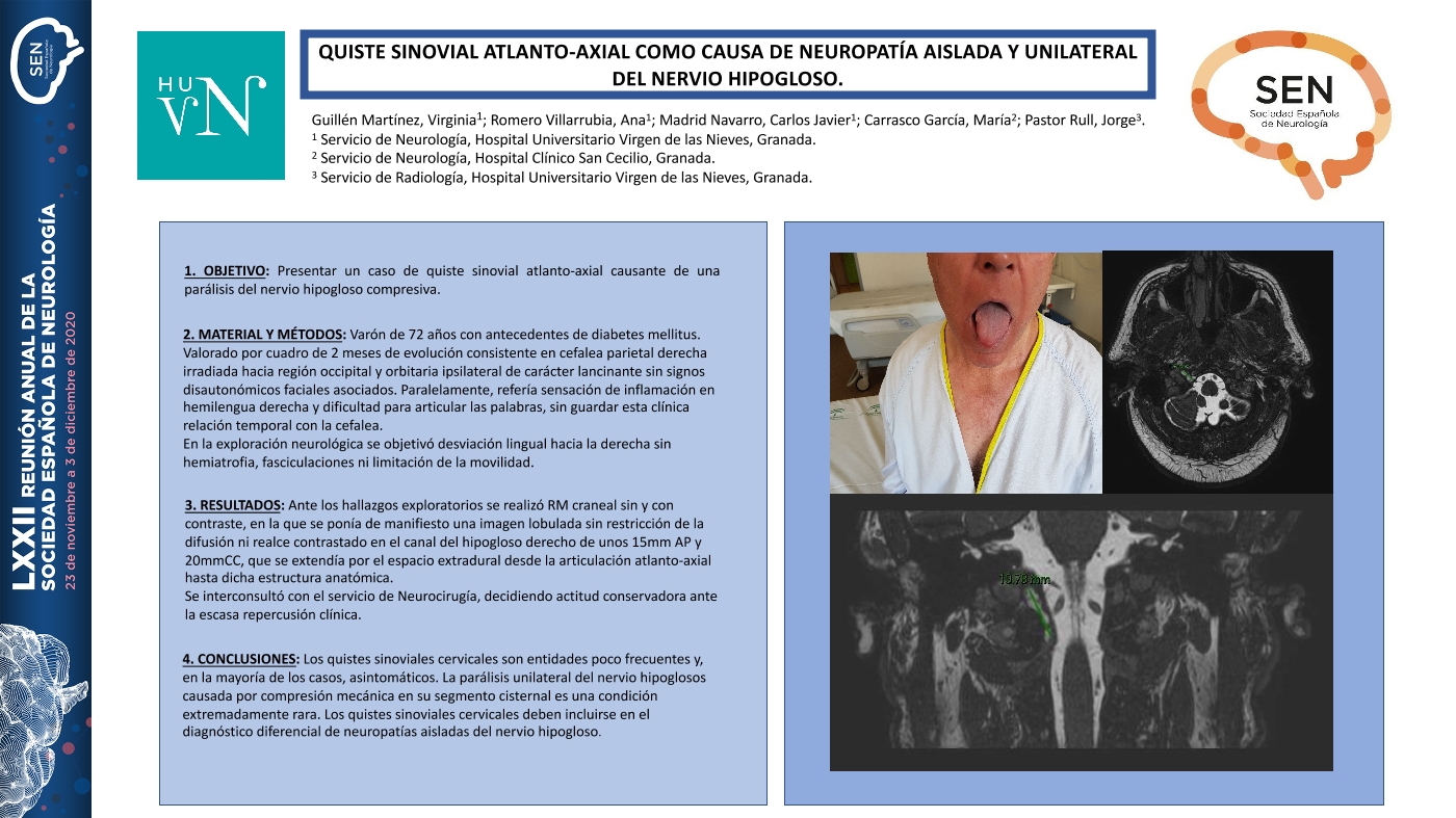 Quiste sinovial atlanto-axial como causa de neuropatía aislada y unilateral del nervio hipogloso.