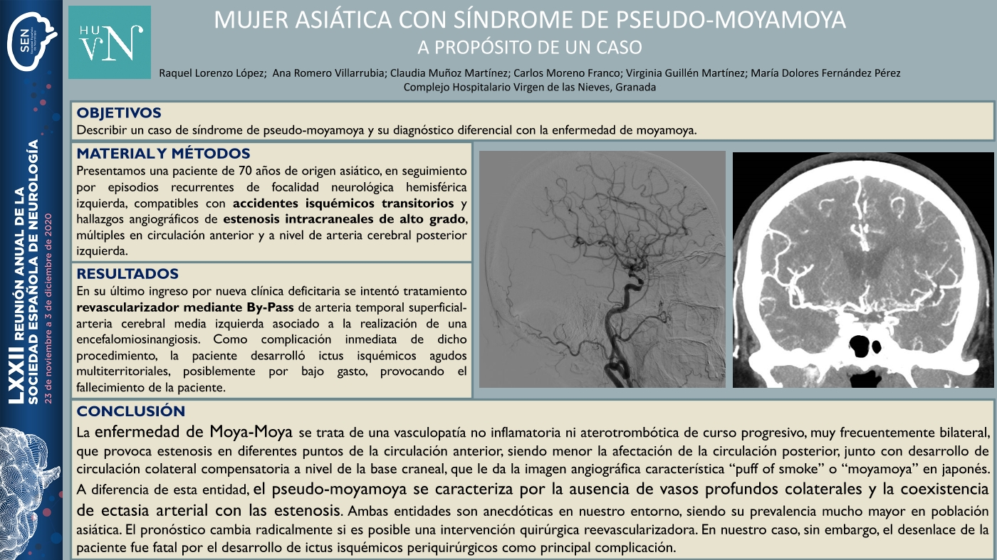 Mujer asiática con síndrome de pseudo-moyamoya. A propósito de un caso.
