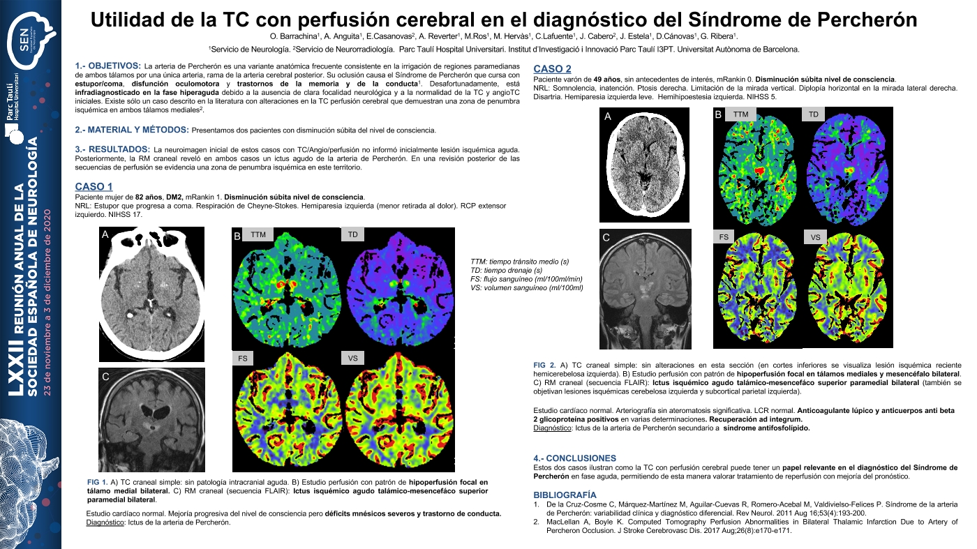 Utilidad de la TC con perfusión cerebral en el diagnóstico del Síndrome de Percheron.