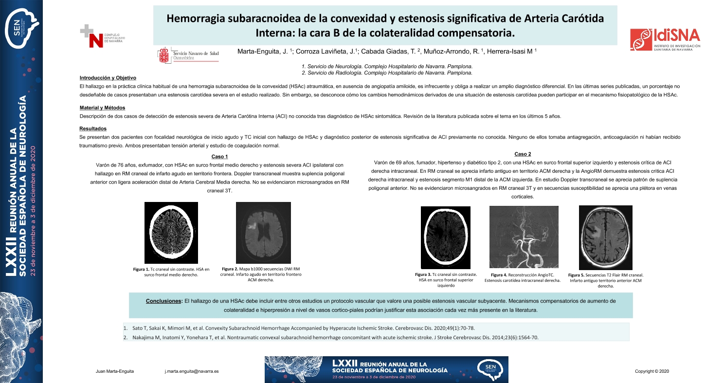 Hemorragia subaracnoidea de la convexidad y estenosis significativa de Arteria Carótida Interna: la cara B de la colateralidad compensatoria