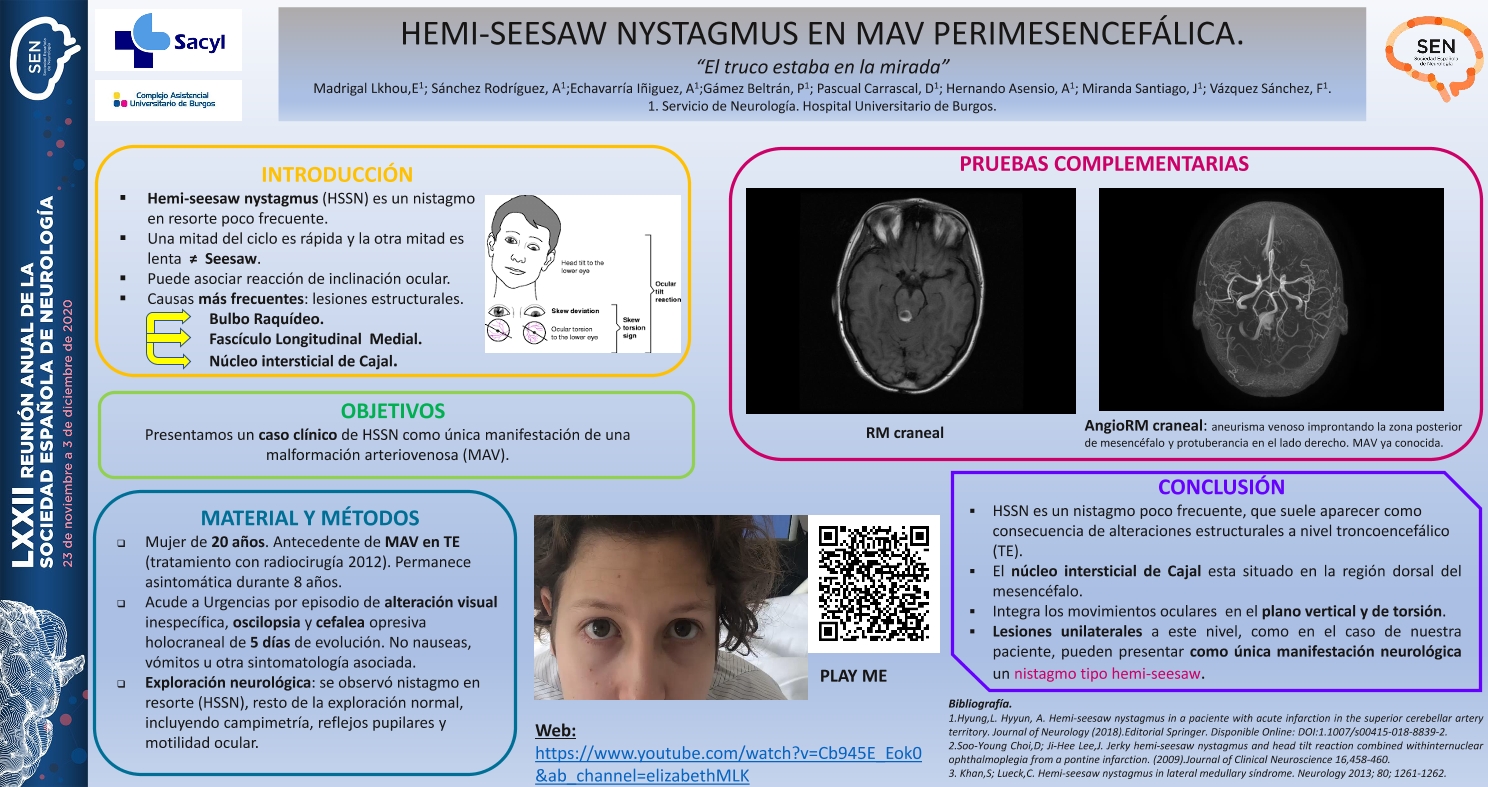 Hemi-seesaw nystagmus como manifestación de malformación arteriovenosa perimesencefálica