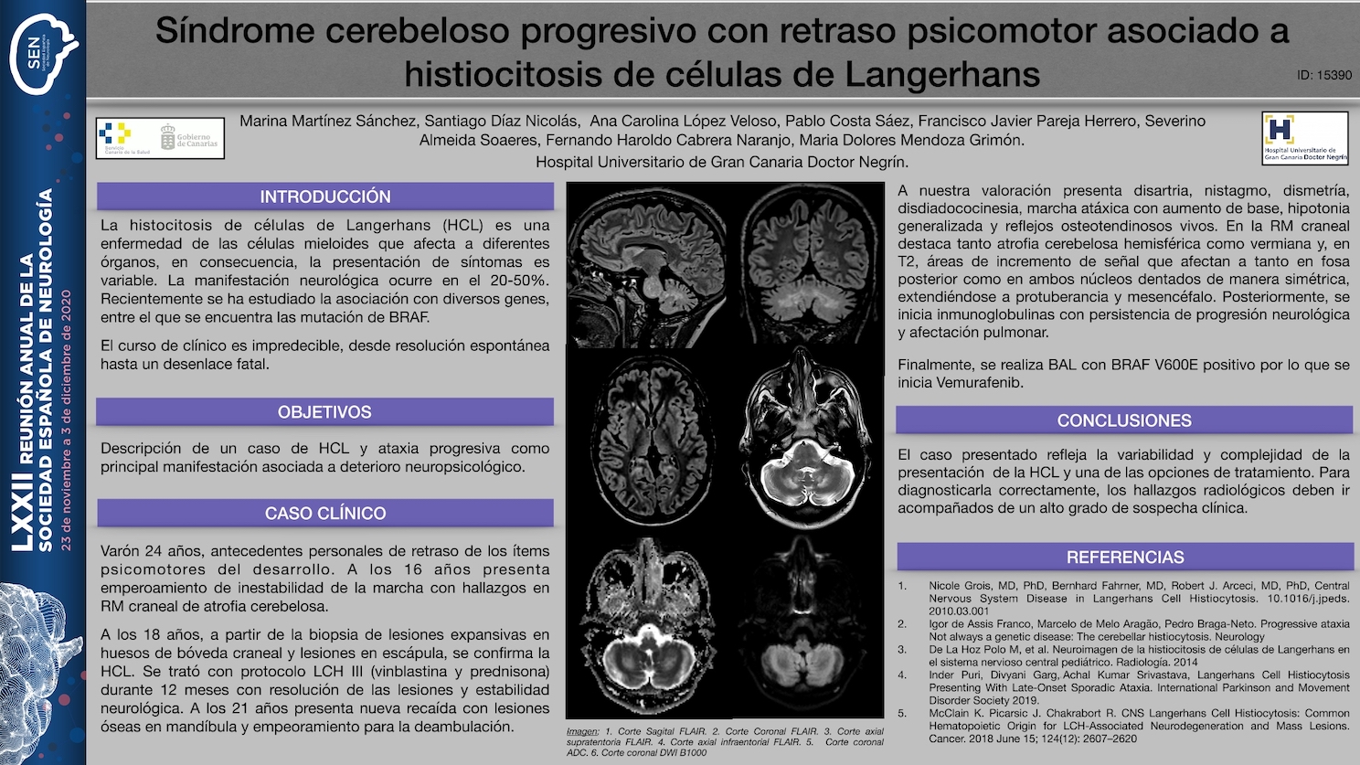 Síndrome cerebeloso progresivo con retraso psicomotor secundario a histiocitosis de células de Langerhans
