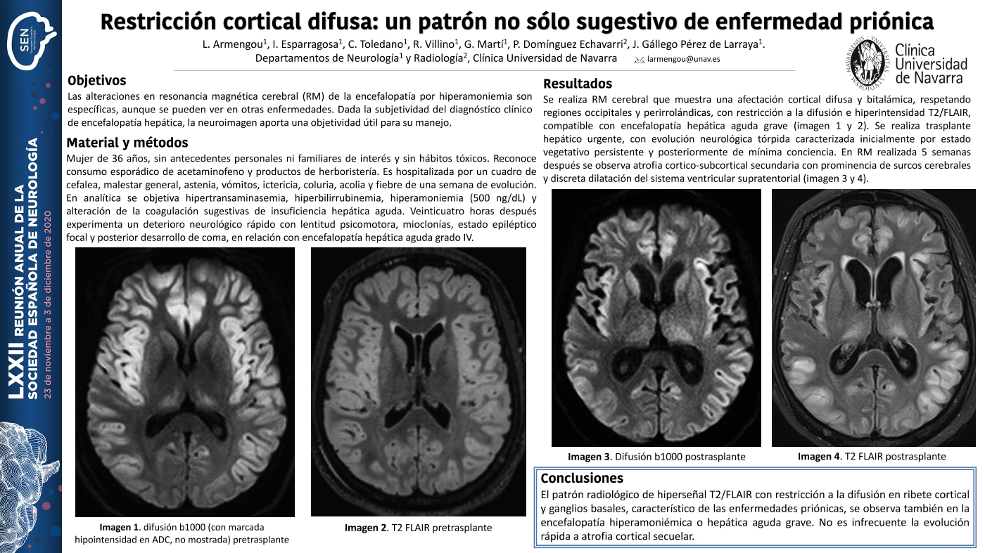 Restricción cortical difusa: un patrón no sólo sugestivo de enfermedad priónica.