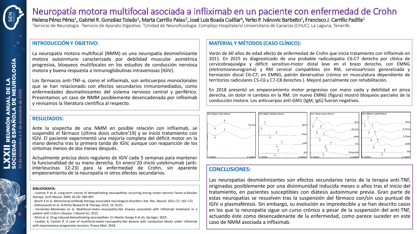 Neuropatía motora multifocal asociada a infliximab en un paciente con enfermedad de Crohn
