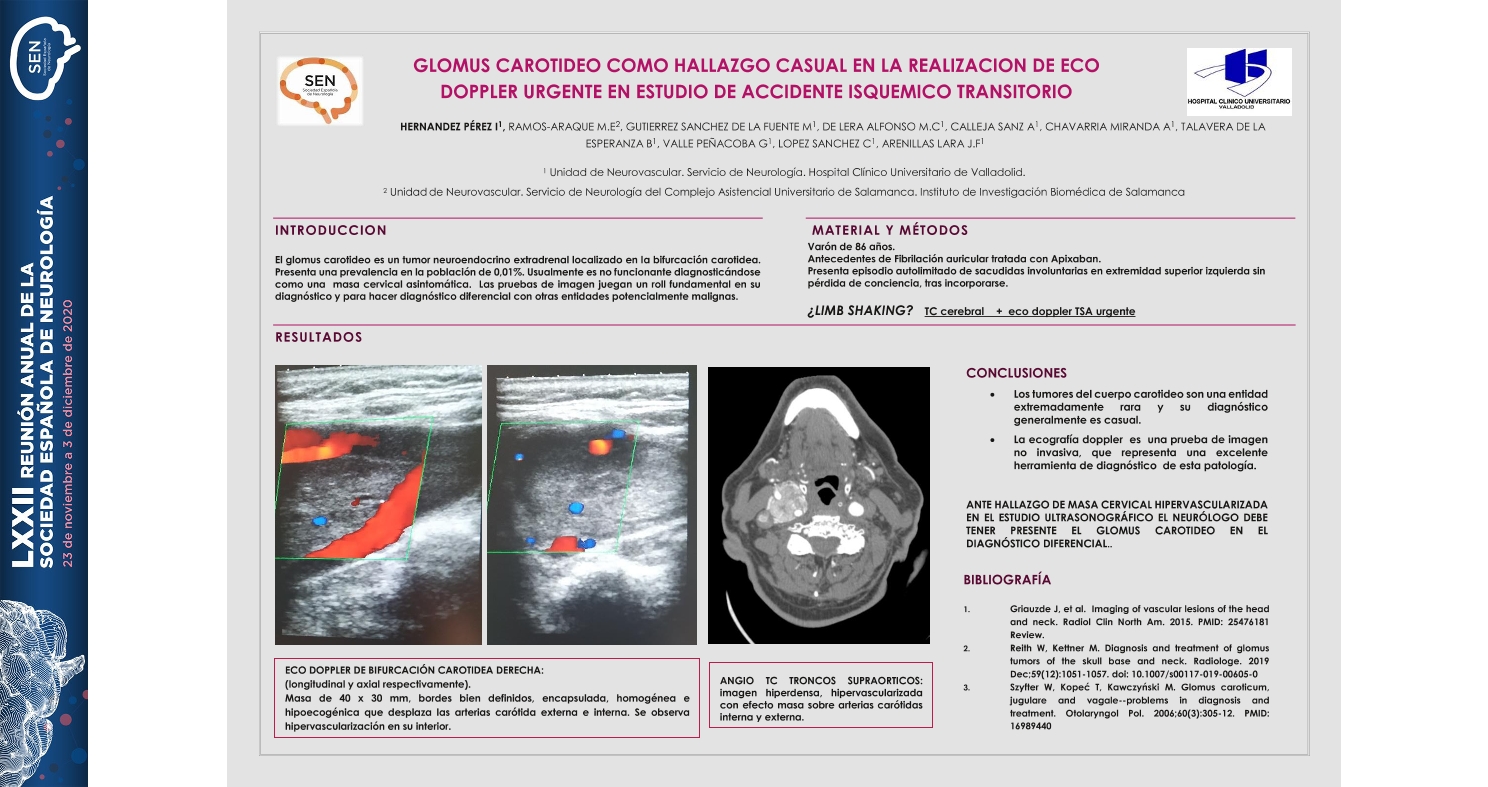 Glomus carotideo como hallazgo casual en la realización de eco doppler urgente en estudio de accidente isquémico transitorio