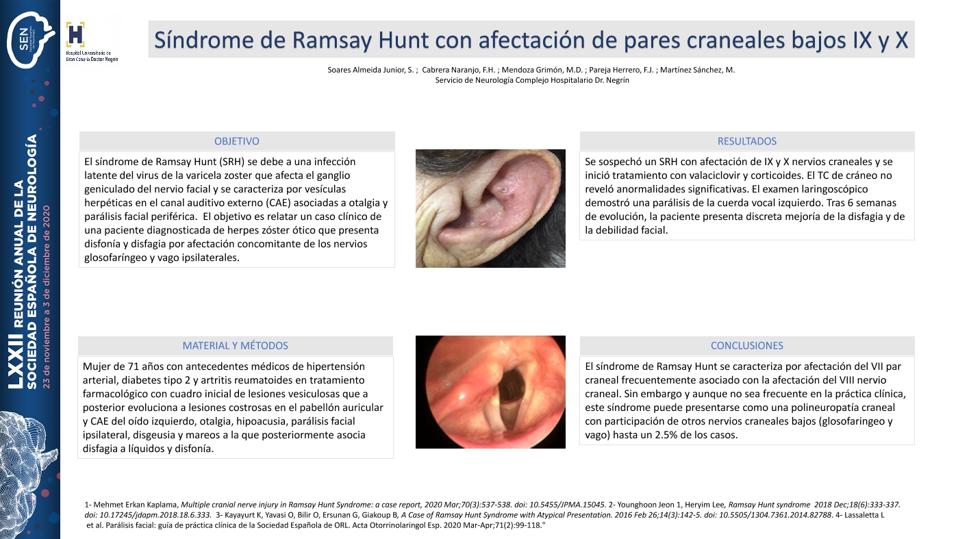Síndrome de Ramsay Hunt con afectación de pares craneales bajos IX y X