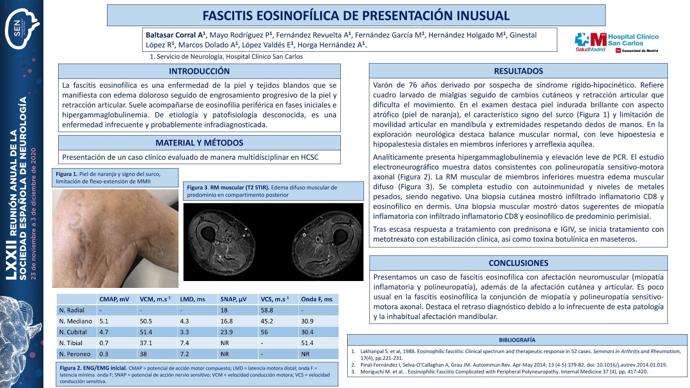 Fascitis eosinofílica de presentación inusual
