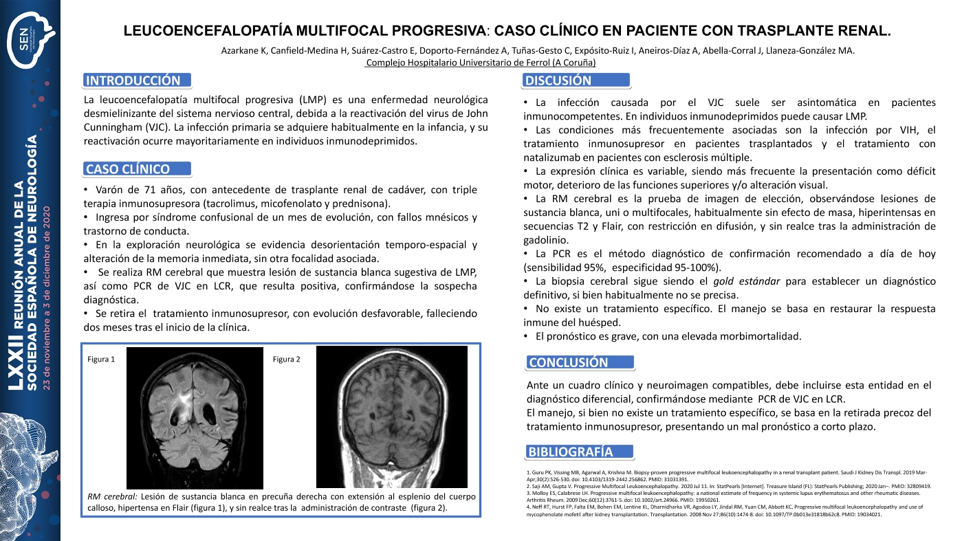 Leucoencefalopatía multifocal progresiva: caso clínico en paciente con trasplante renal