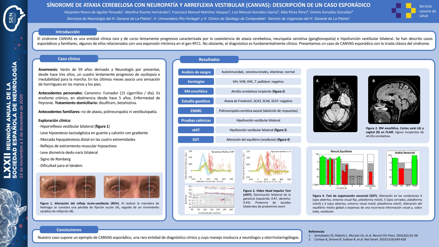Síndrome de ataxia cerebelosa con neuropatía y arreflexia vestibular (CANVAS): descripción de un caso esporádico