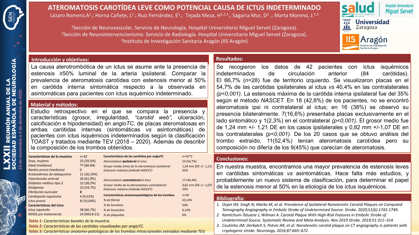 Ateromatosis carotídea leve como potencial causa de ictus indeterminado