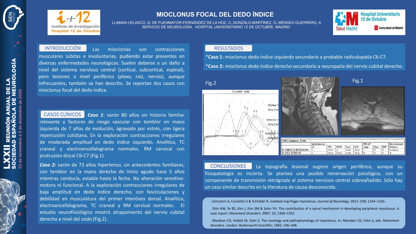 Mioclonus focal del dedo índice.