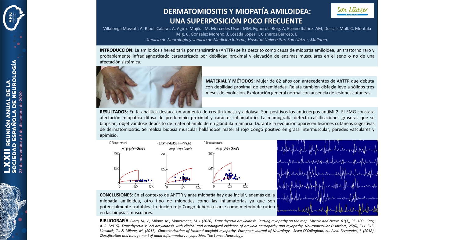 Dermatomiositis en amiloidosis hereditaria por TTR