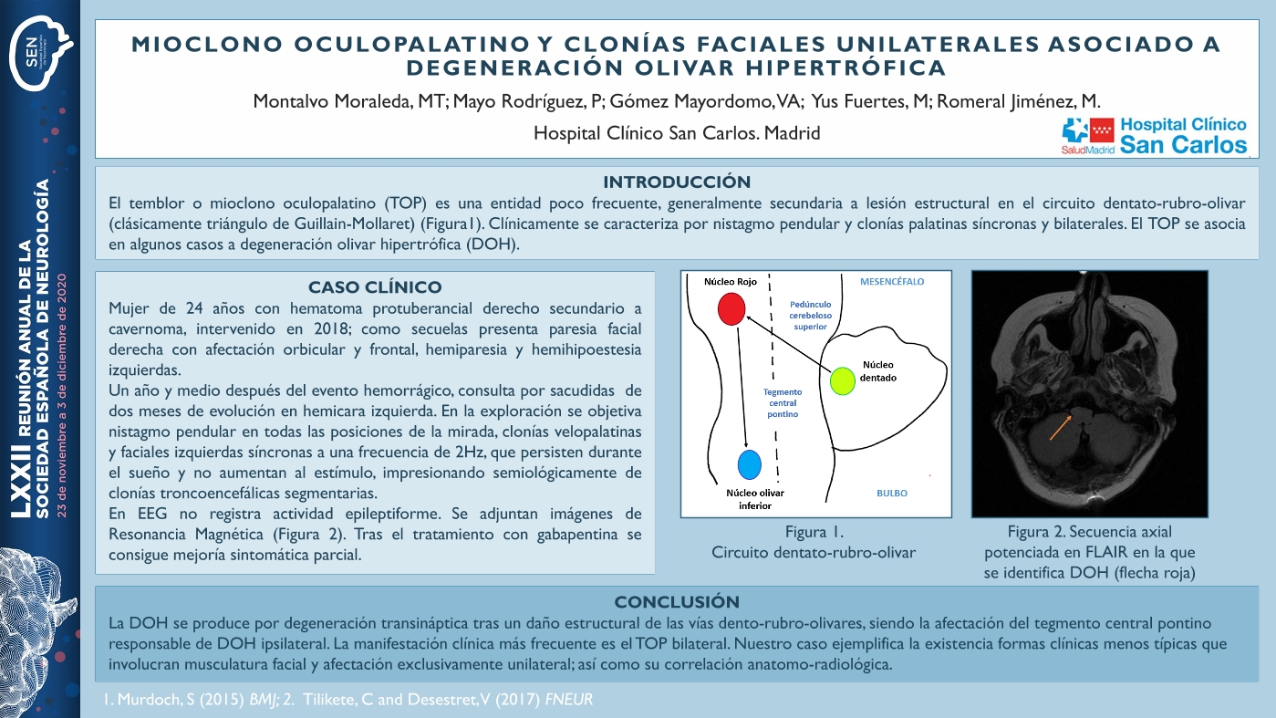 Mioclono oculopalatino y clonías faciales unilaterales asociado a degeneración olivar hipertrófica