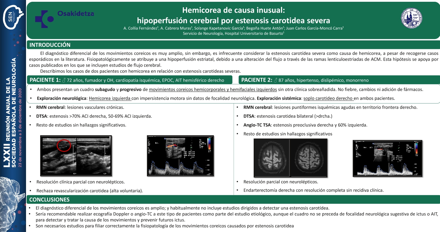 Hemicorea de causa inusual: hipoperfusión cerebral por estenosis carotidea severa