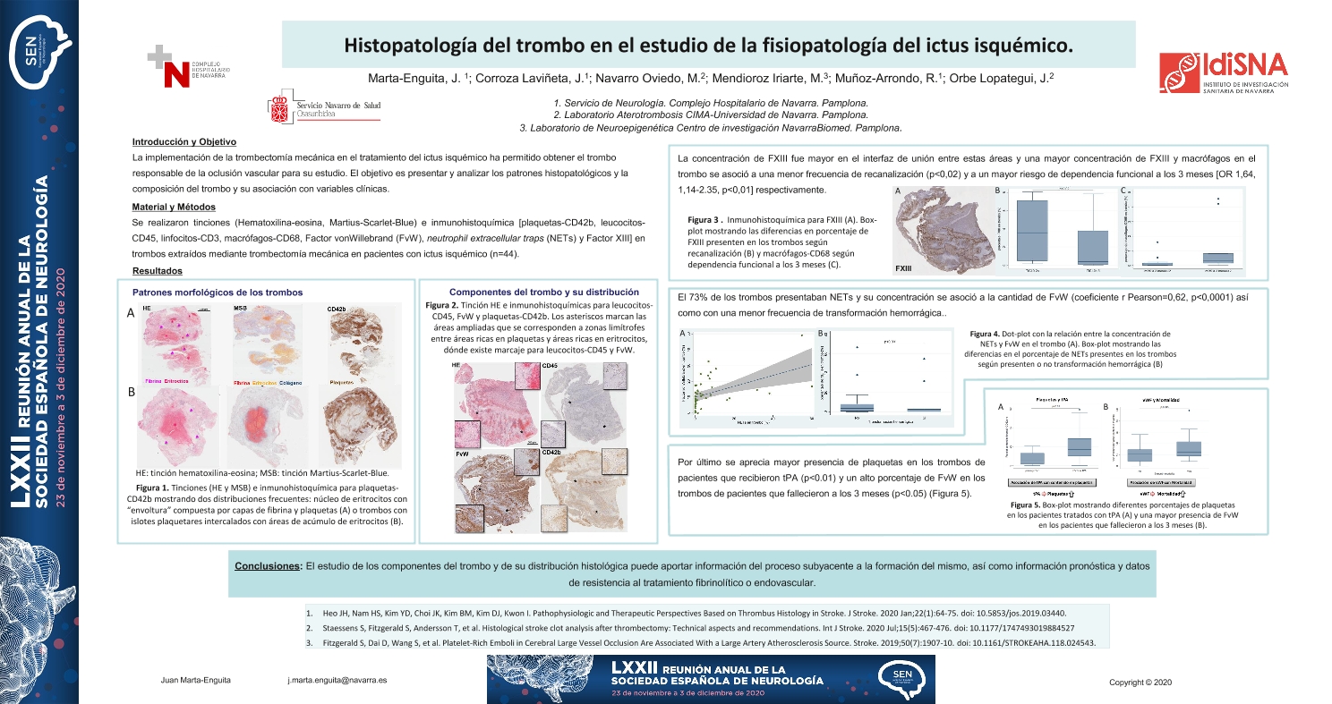 Histopatología del trombo en el estudio de la fisiopatología del ictus isquémico