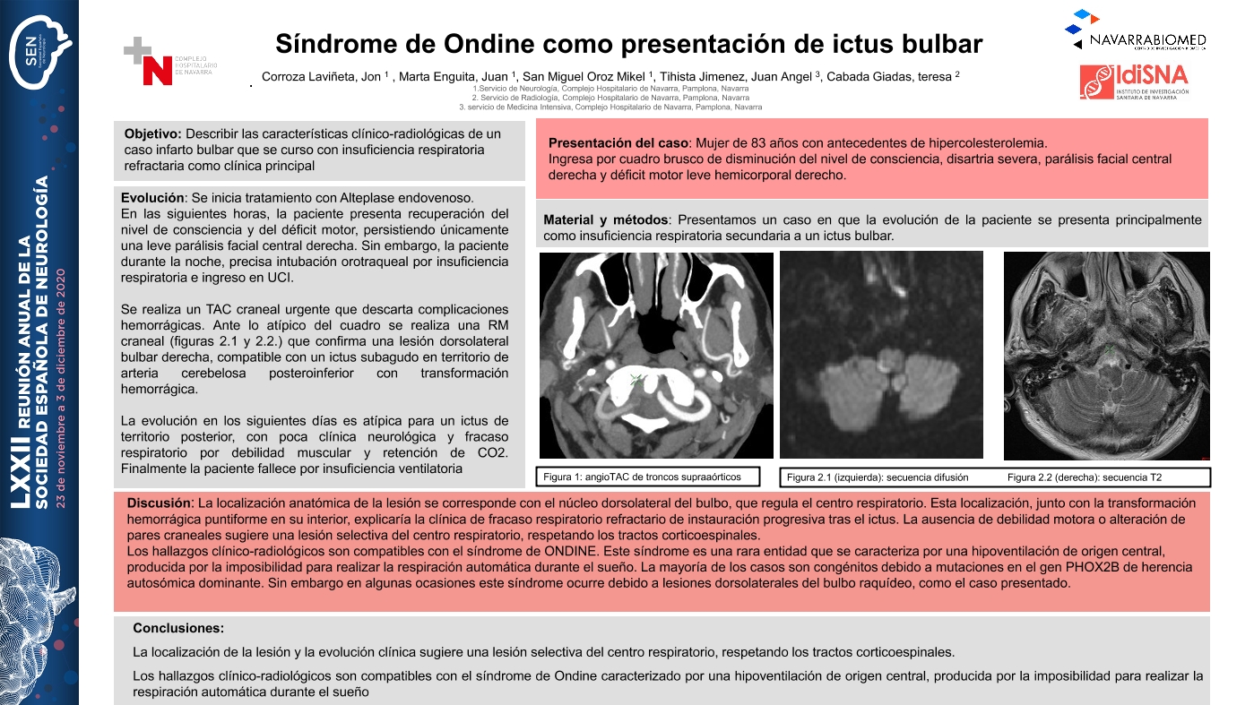 Síndrome de Ondine como presentación de ictus bulbar