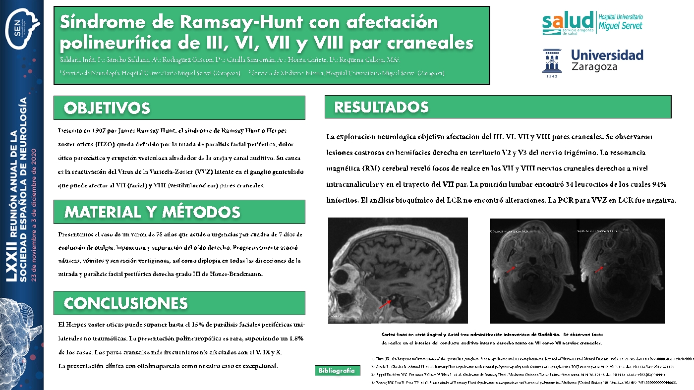 Síndrome de Ramsay-Hunt con afectación polineurítica de III, VI, VII y VIII par craneales