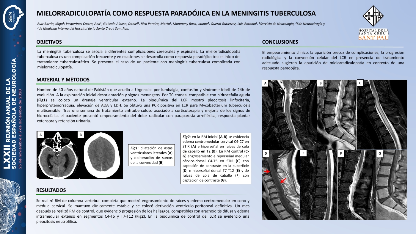 Mielorradiculopatía como respuesta paradójica en la meningitis tuberculosa