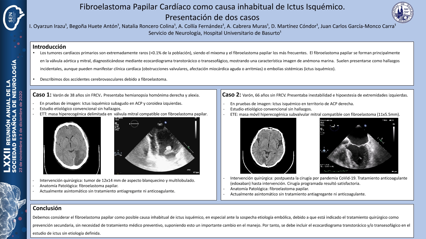 Fibroelastoma Papilar Cardíaco como causa inhabitual de Ictus Isquémico. Presentación de dos casos