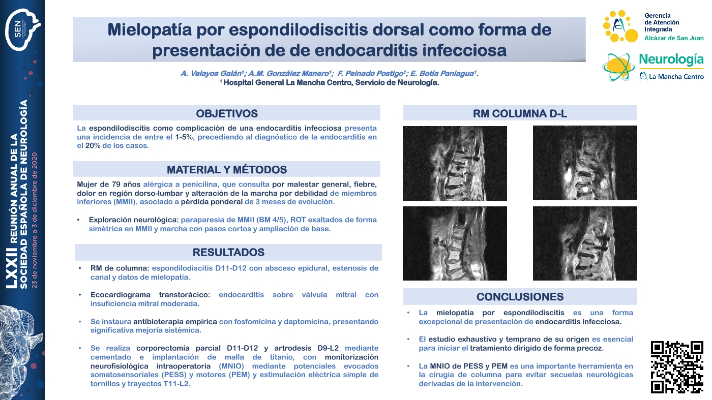 Mielopatía por espondilodiscitis dorsal como forma de presentación de de endocarditis infecciosa