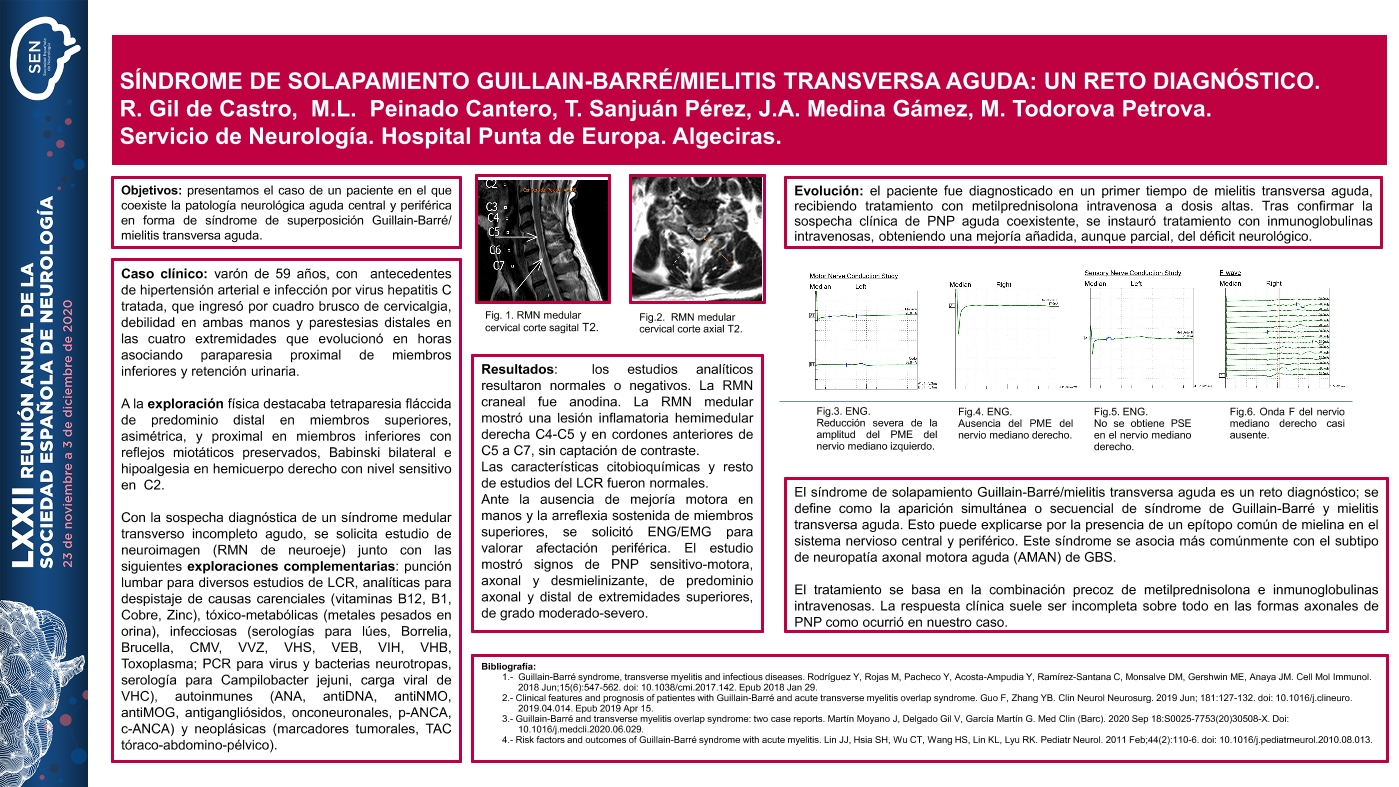SÍNDROME DE SOLAPAMIENTO GUILLAIN-BARRÉ/MIELITIS TRANSVERSA AGUDA: UN RETO DIAGNÓSTICO.