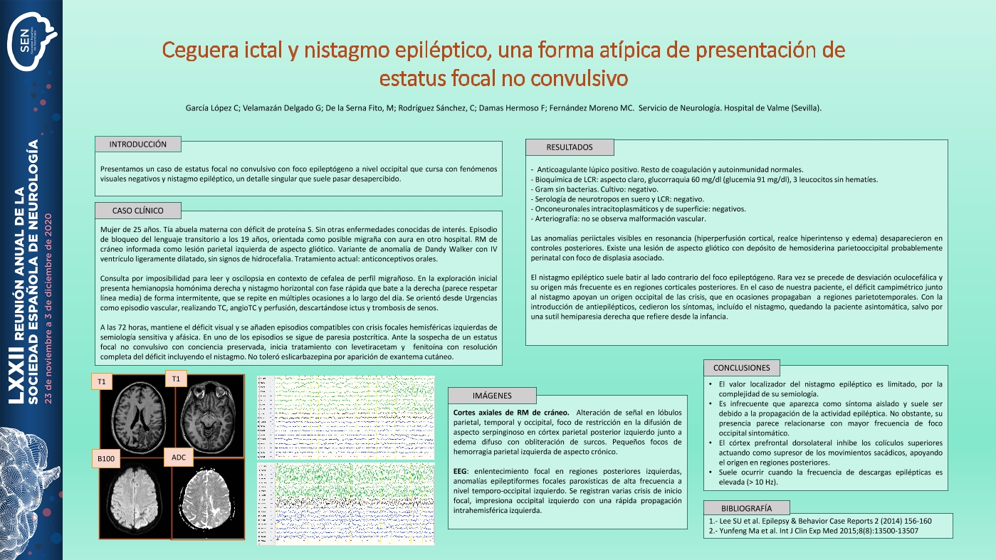 Ceguera ictal y nistagmo epiléptico, una forma atípica de presentación de estatus focal no convulsivo