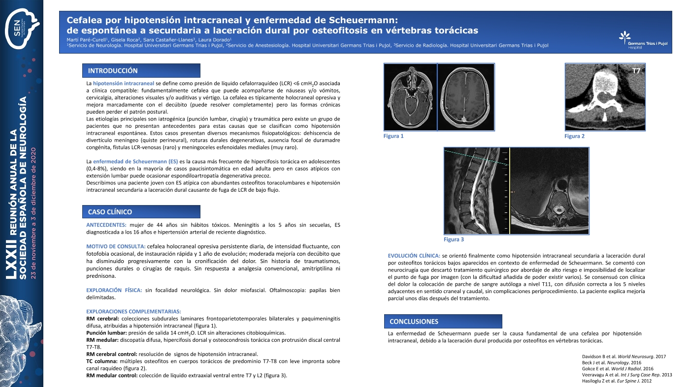 Cefalea por hipotensión licuoral y enfermedad de Scheuermann: de espontánea a secundaria a laceración dural por osteofitosis en vértebras torácicas
