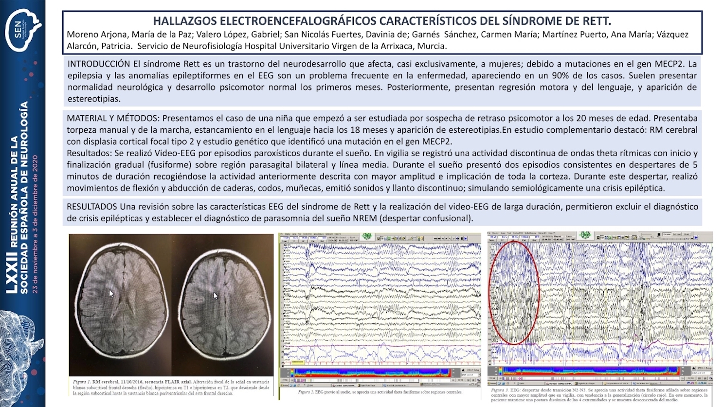 Hallazgos electroencefalográficos característicos del síndrome de Rett