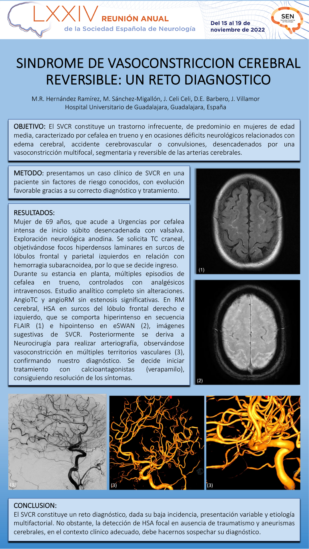 Síndrome de vasoconstricción cerebral reversible: un reto diagnóstico