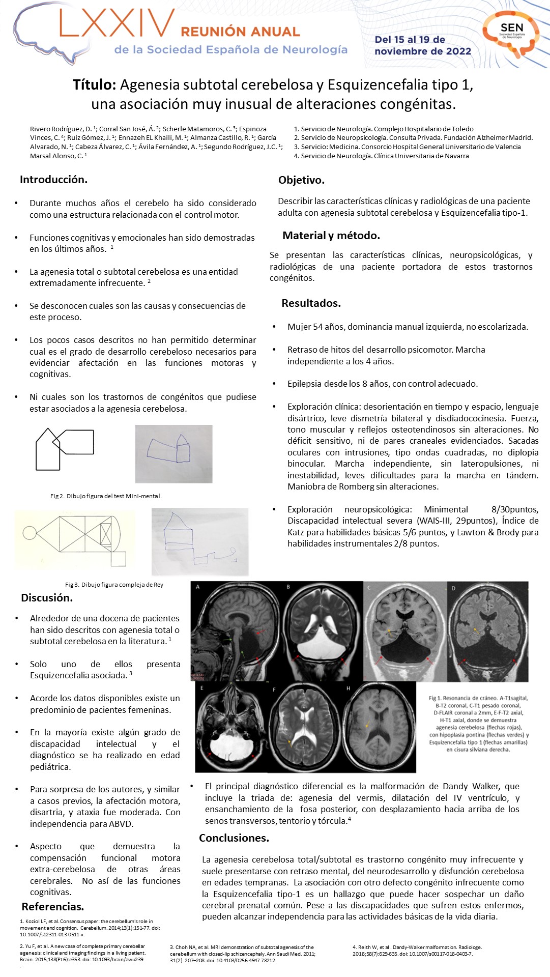 Agenesia subtotal cerebelosa y Esquizencefalia tipo 1, una asociación muy inusual de alteraciones congénitas