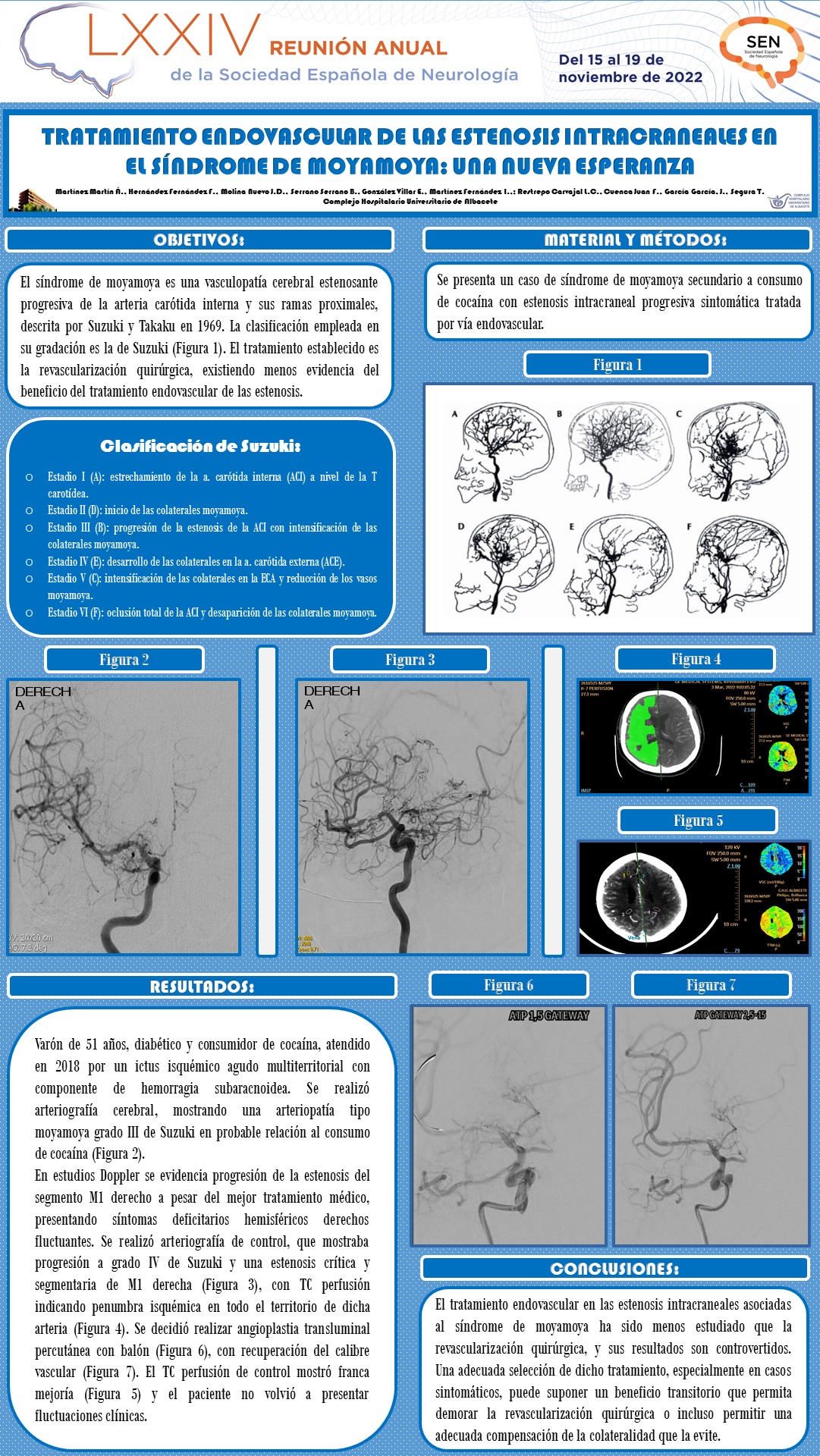 Tratamiento endovascular de las estenosis intracraneales en el síndrome de moyamoya: una nueva esperanza