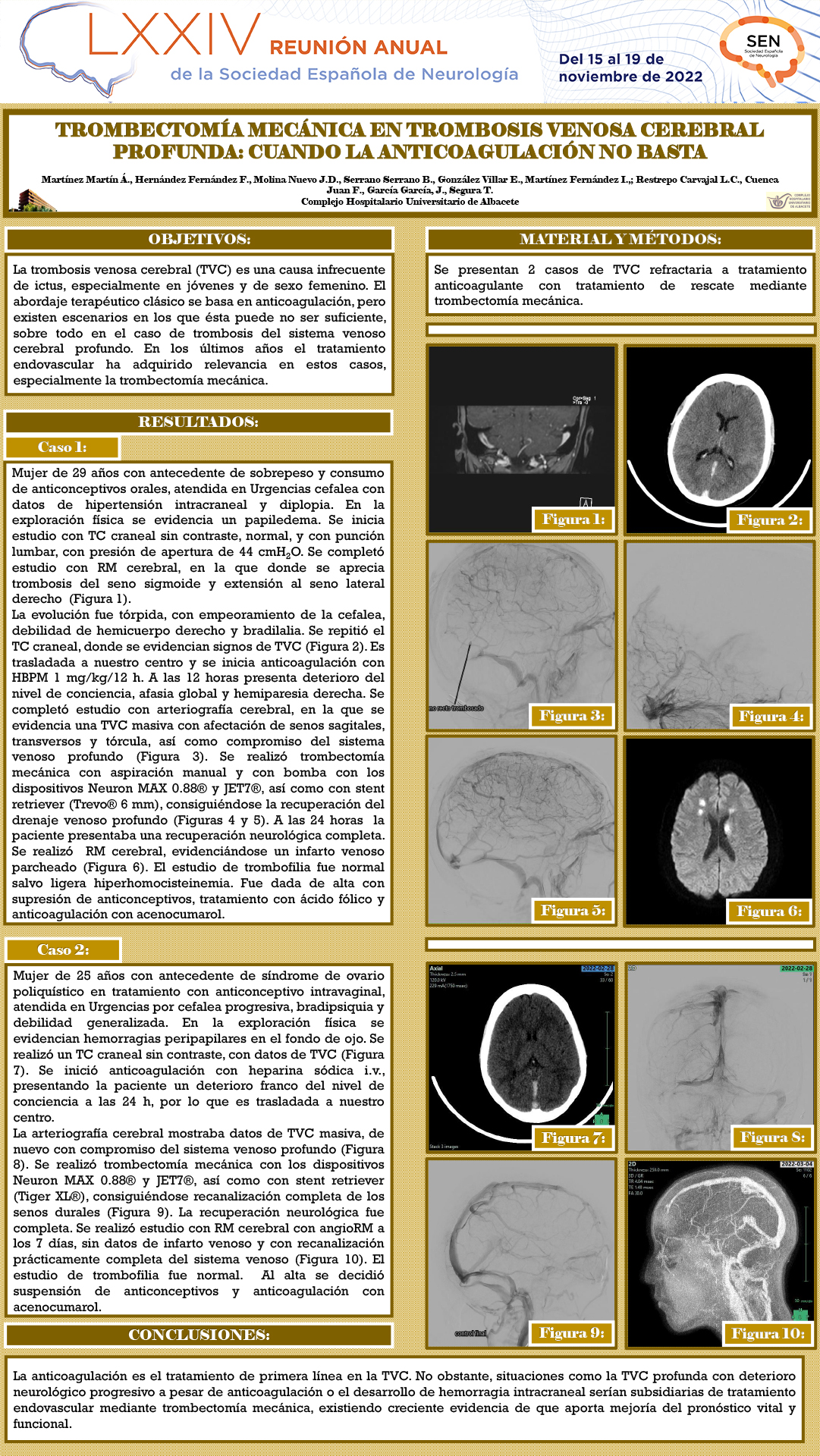 Trombectomía mecánica en trombosis venosa cerebral profunda: cuando la anticoagulación no basta