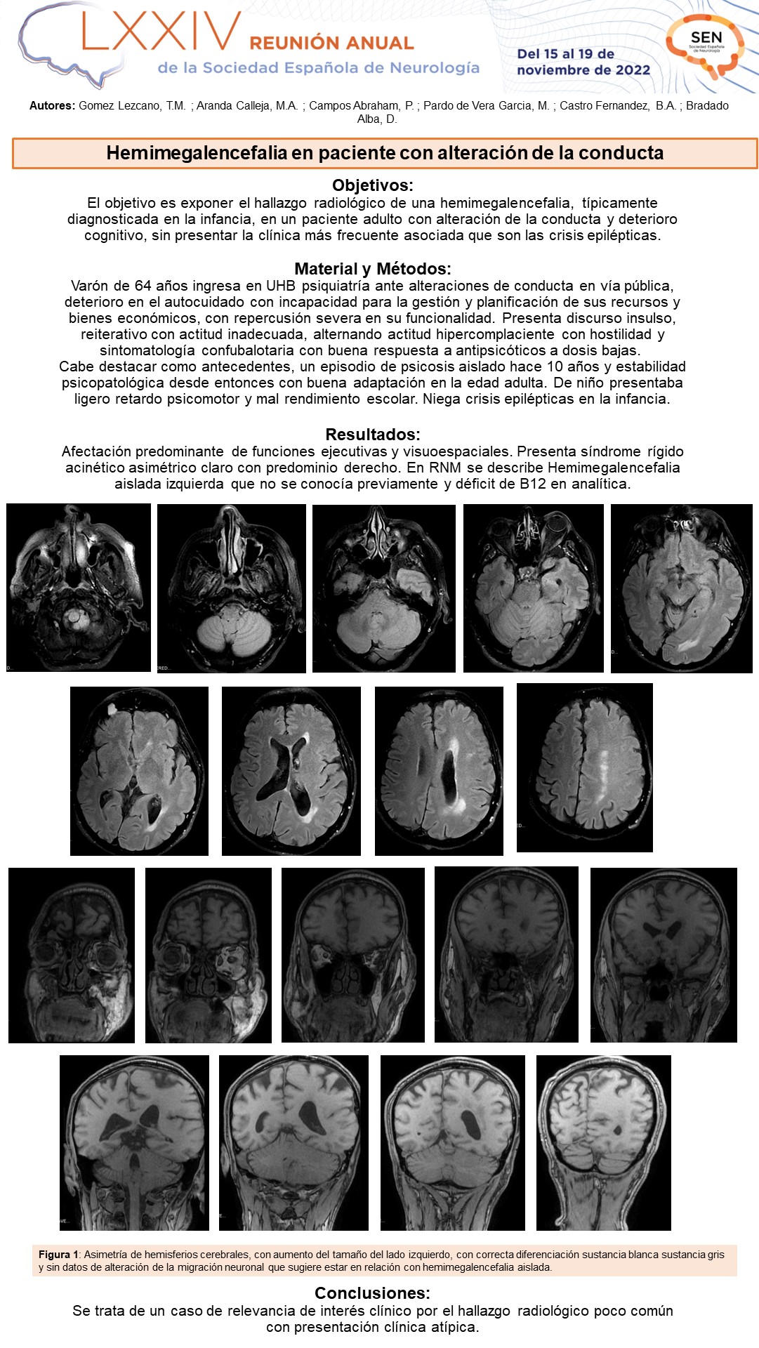 Hemimegalencefalia en paciente con alteración de la conducta