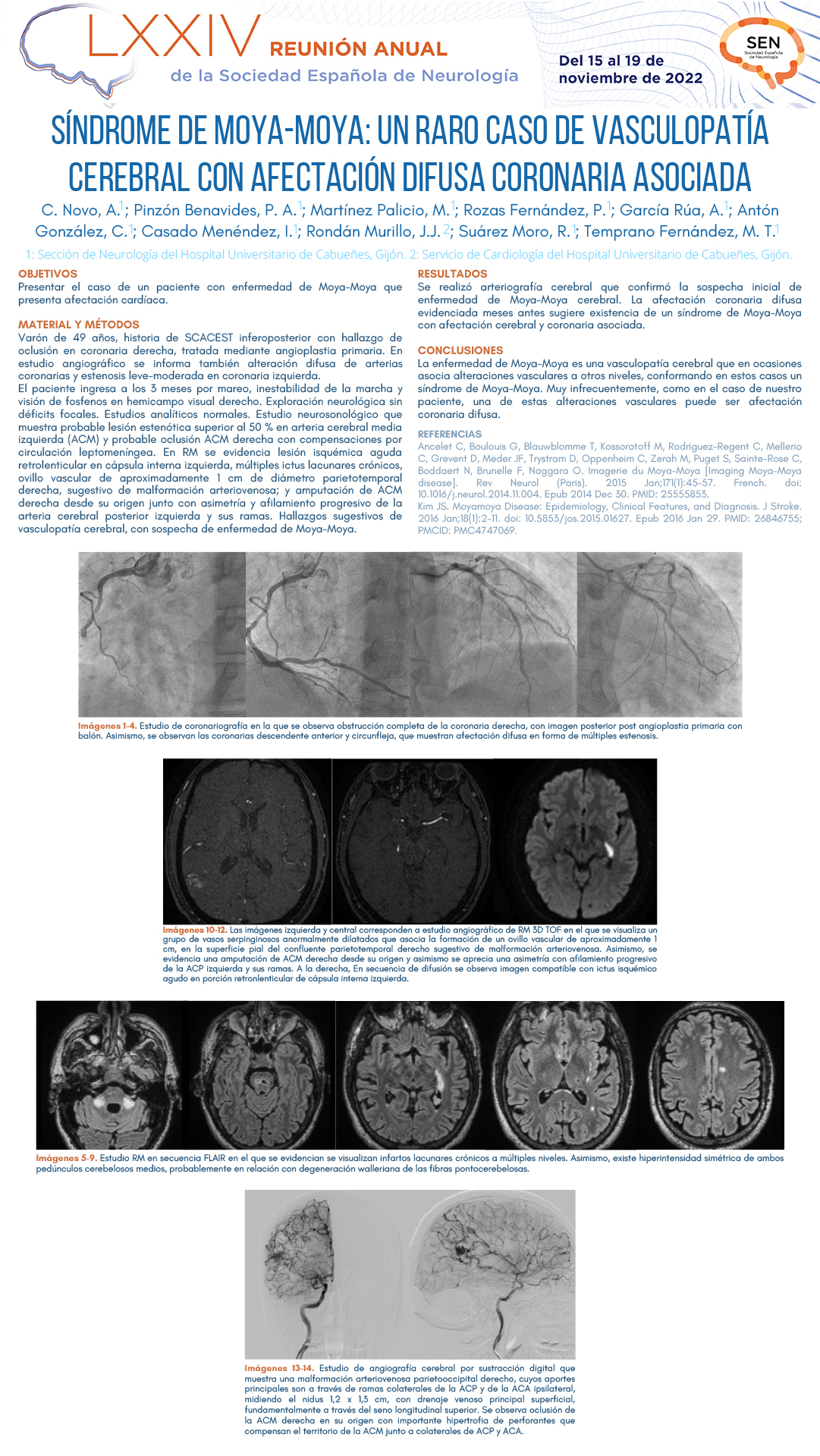 Síndrome de Moya-Moya: un raro caso de vasculopatía cerebral con afectación difusa coronaria asociada