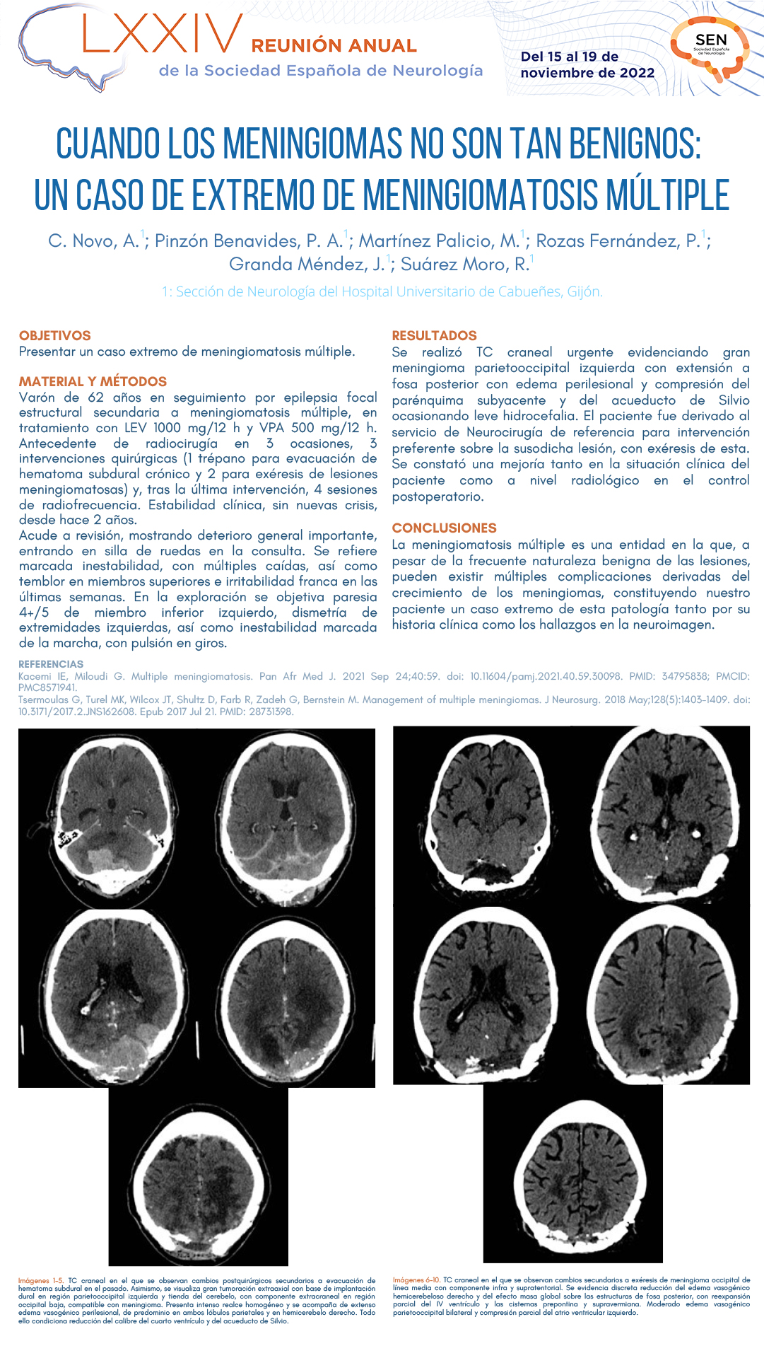 Cuando los meningiomas no son tan benignos: un caso de extremo de meningiomatosis múltiple