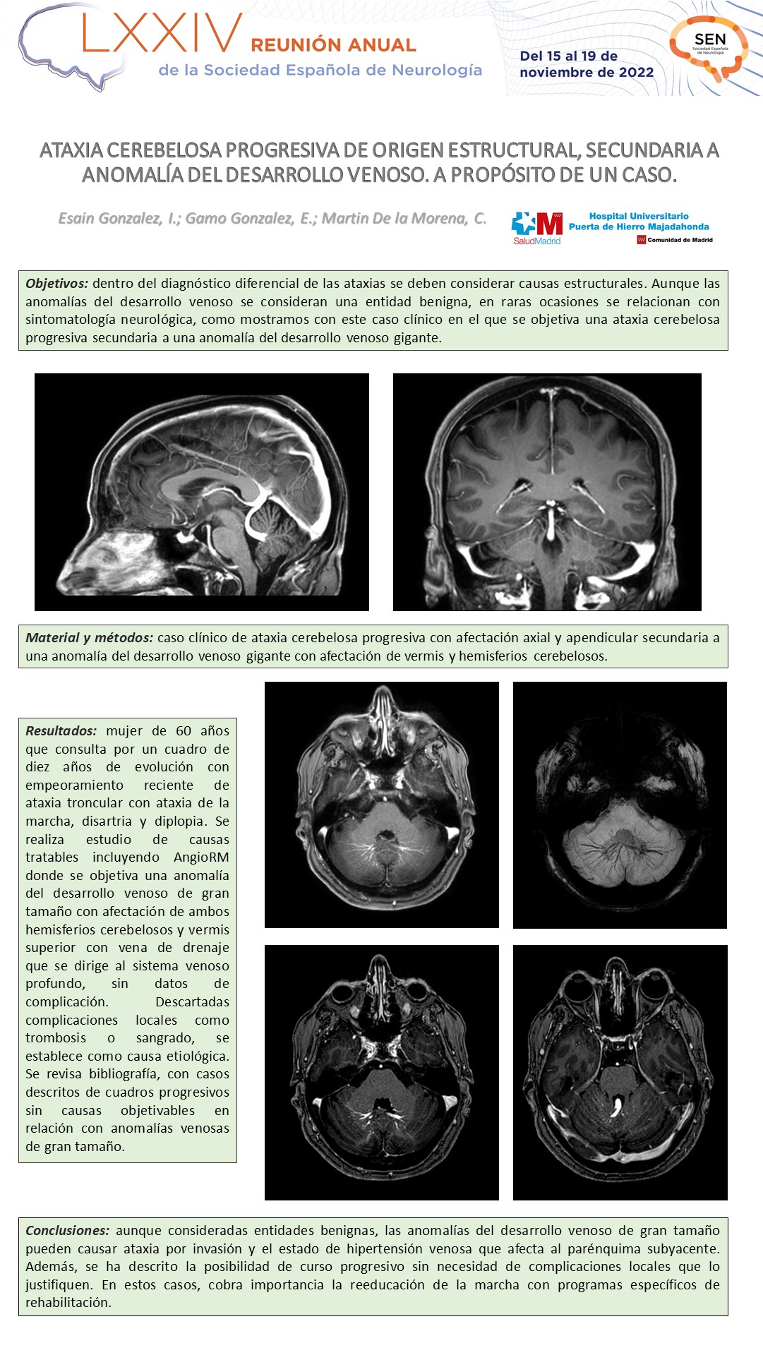 Ataxia cerebelosa progresiva de origen estructural, secundaria a anomalía del desarrollo venoso. A propósito de un caso