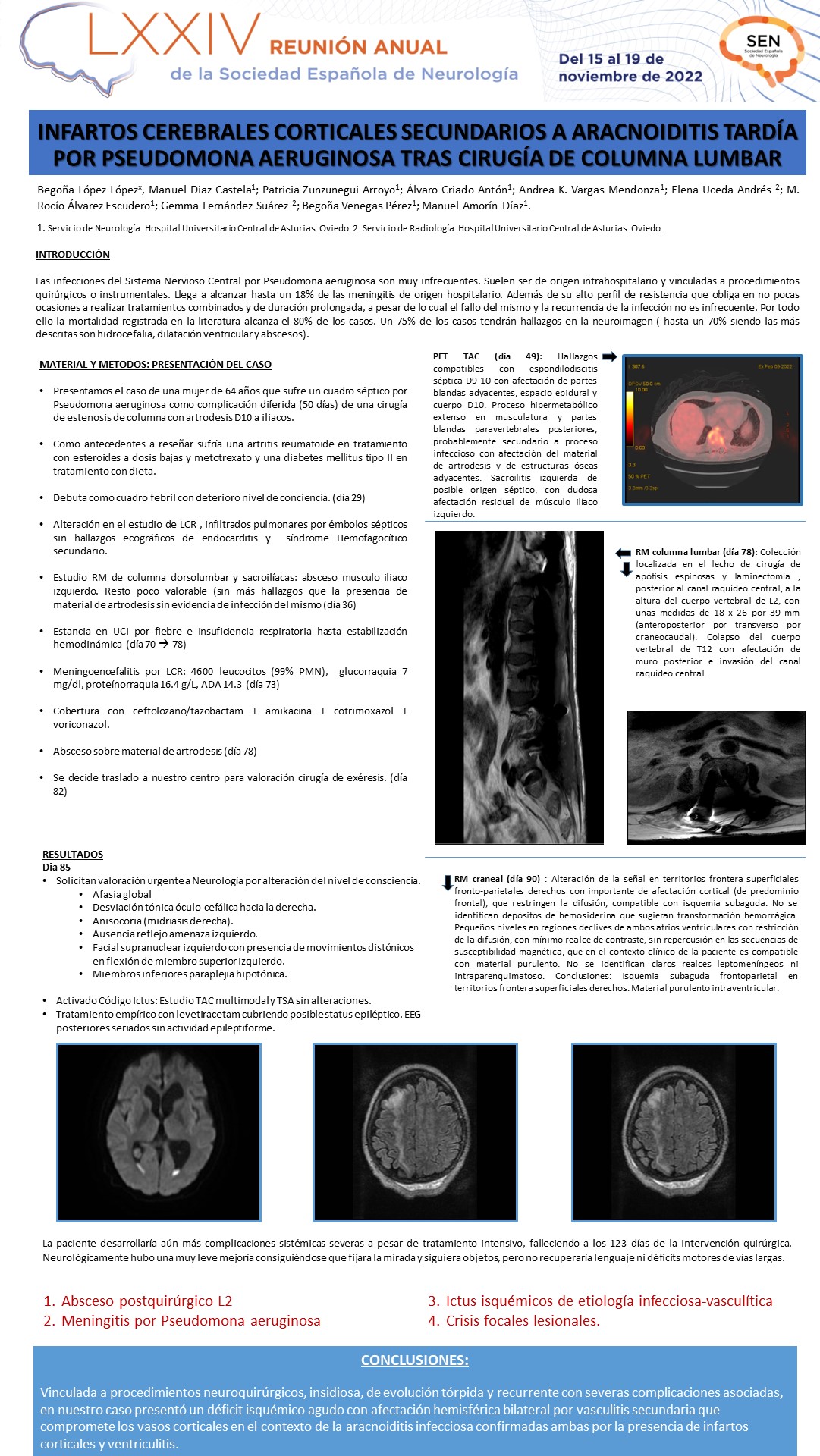 Infartos cerebrales corticales secundarios a aracnoiditis tardía por pseudomona aeruginosa tras cirugía de columna lumbar