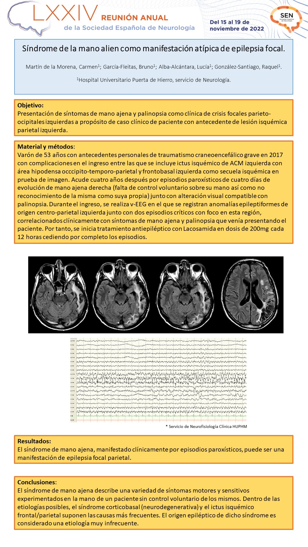 Síndrome de la mano alien como manifestación atípica de epilepsia focal