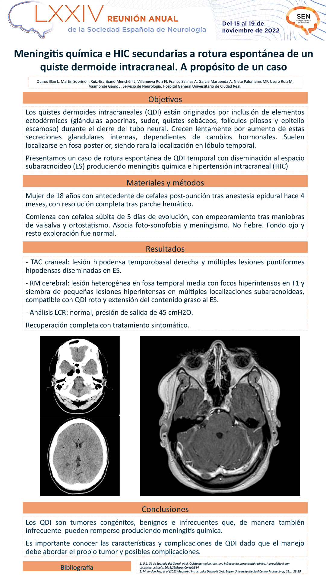 Meningitis química e hipertensión intracraneal secundarias a rotura espontánea de un quiste dermoide intracraneal (QDI). A propósito de un caso