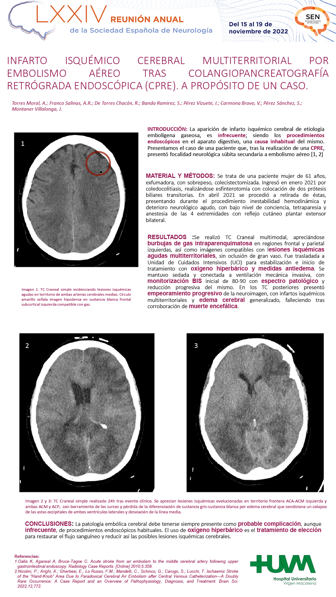 Infarto isquémico cerebral multiterritorial por embolismo aéreo tras Colangiopancreatografía retrógrada endoscópica  (CPRE). A propósito de un caso