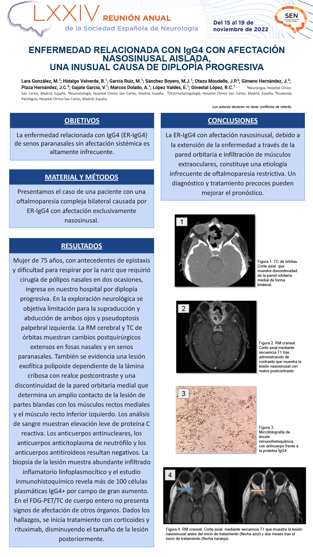 Enfermedad relacionada con IgG4 con afectación nasosinusal aislada, una inusual causa de diplopia progresiva